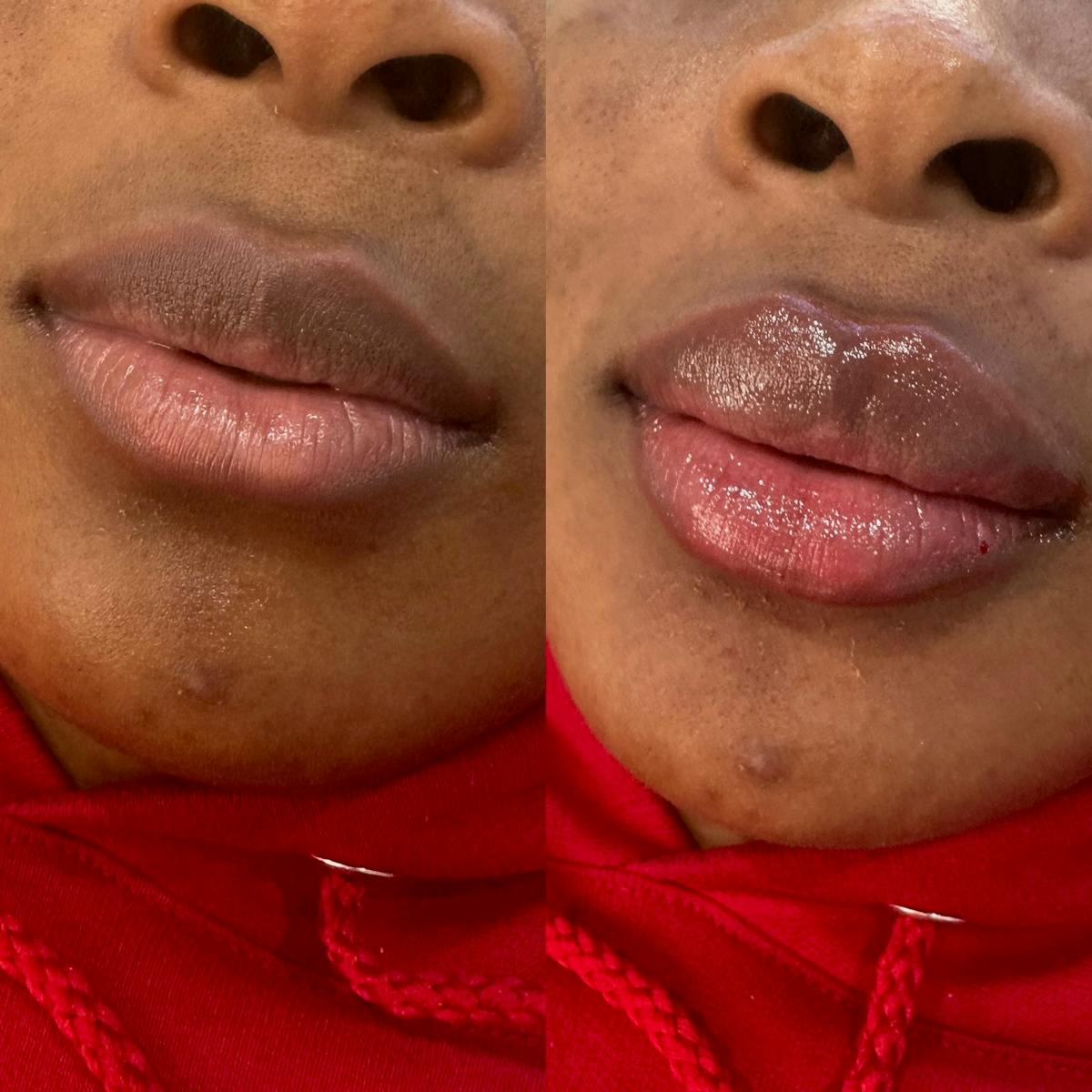 Medspa Services Before & After Gallery - Patient 350916 - Image 1