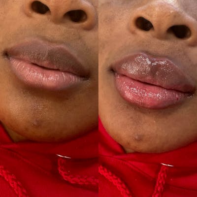 Medspa Services Before & After Gallery - Patient 350916 - Image 1