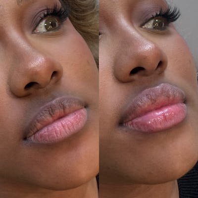 Medspa Services Before & After Gallery - Patient 155677 - Image 1