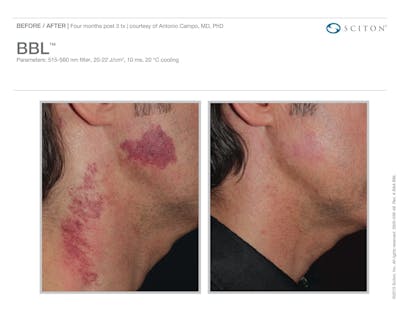 BBL before and after