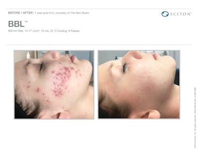 BBL before and after