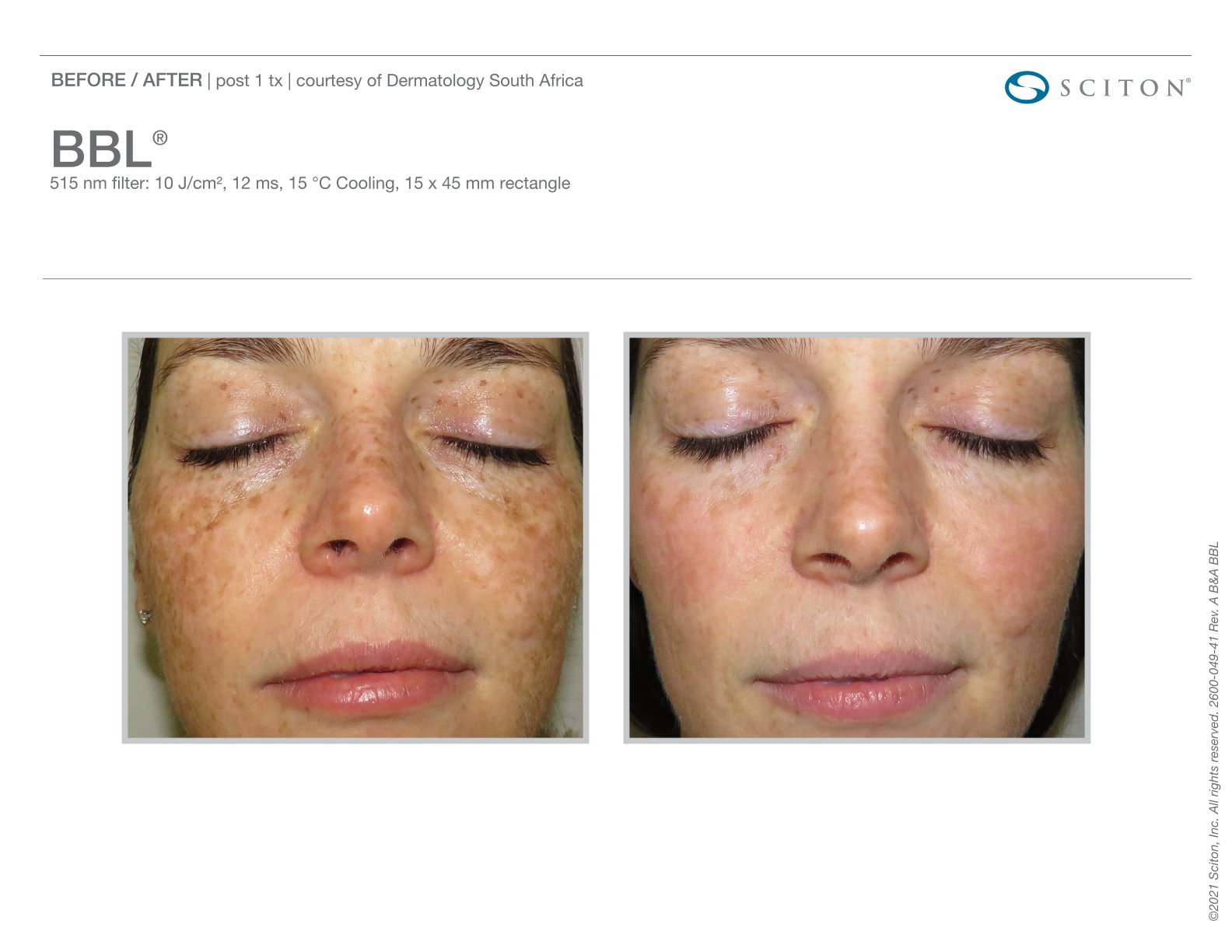 BBL before and after
