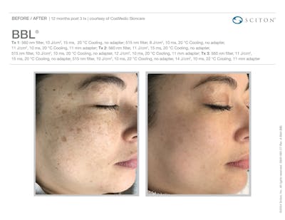 BBL before and after