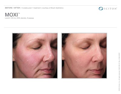 Moxi before and after