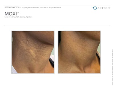 Moxi before and after