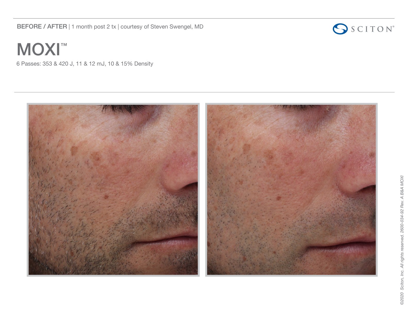 Moxi before and after