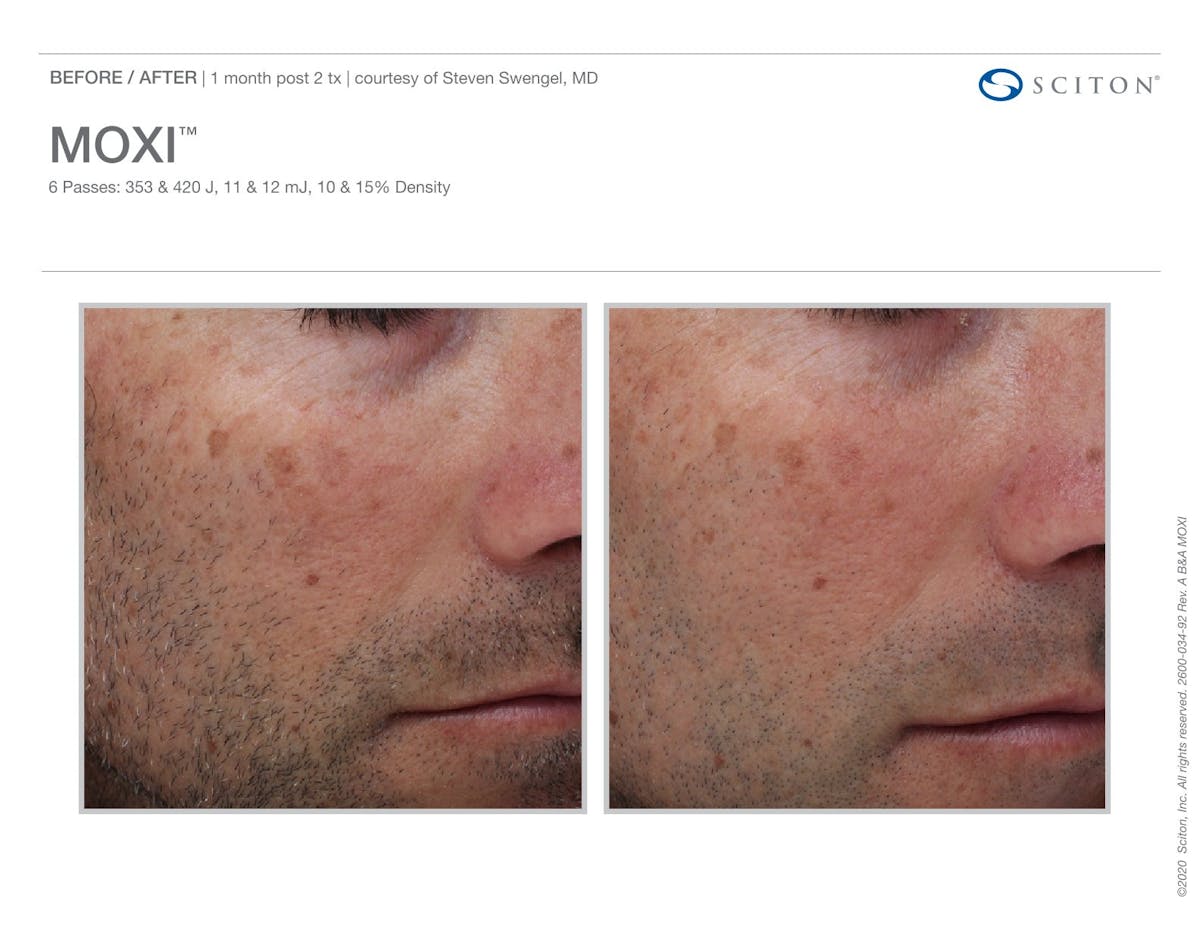 Moxi before and after