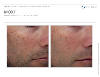 Moxi before and after