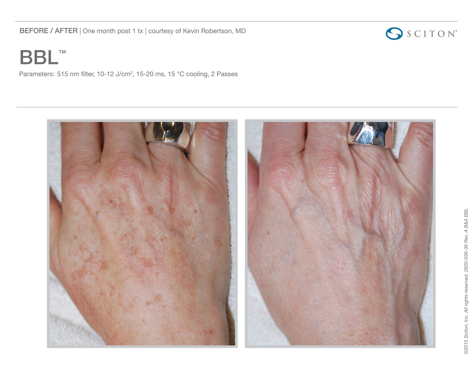 BBL before and after