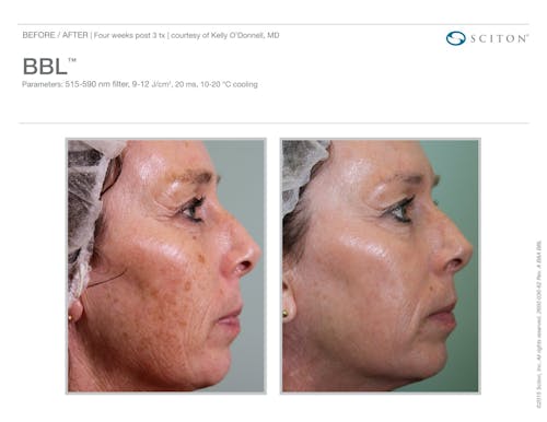 BBL before and after