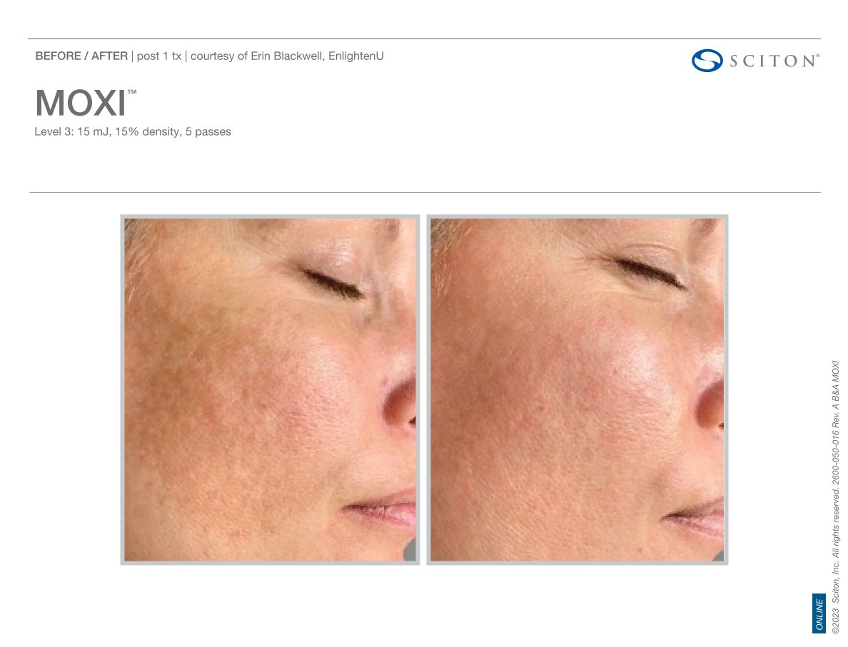 Moxi before and after