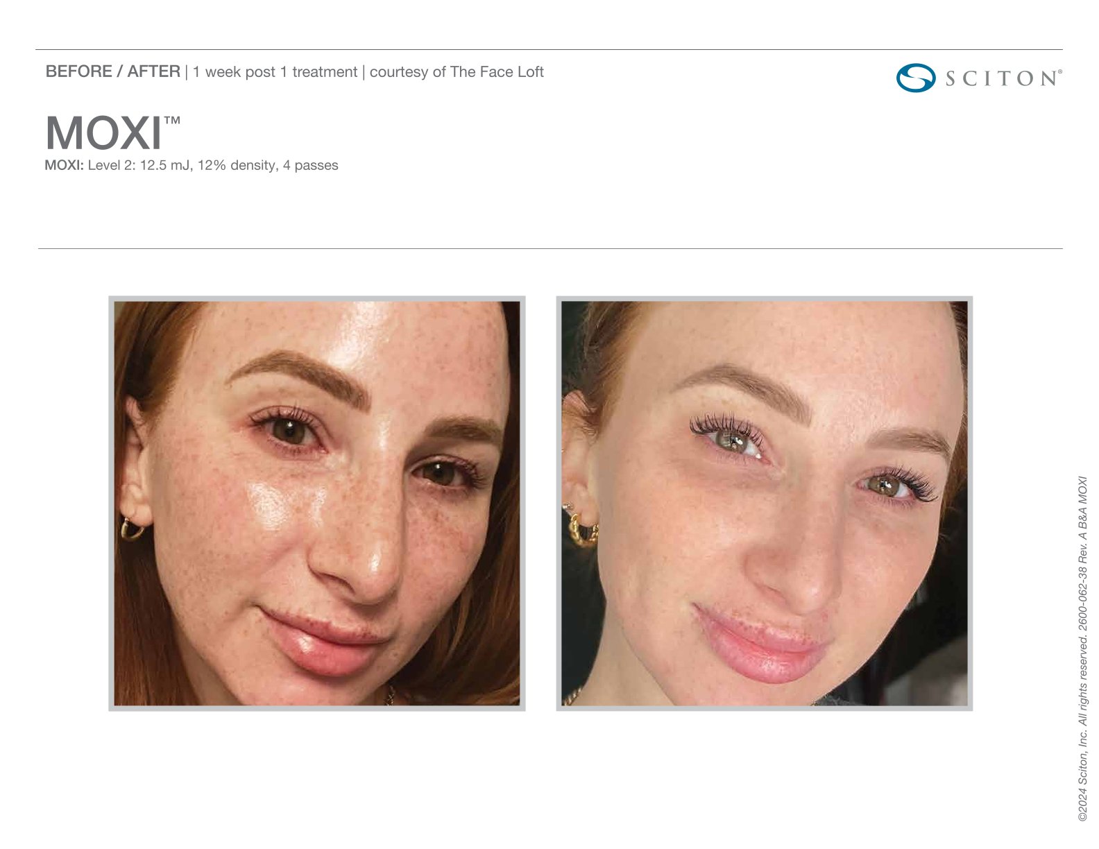 Moxi before and after