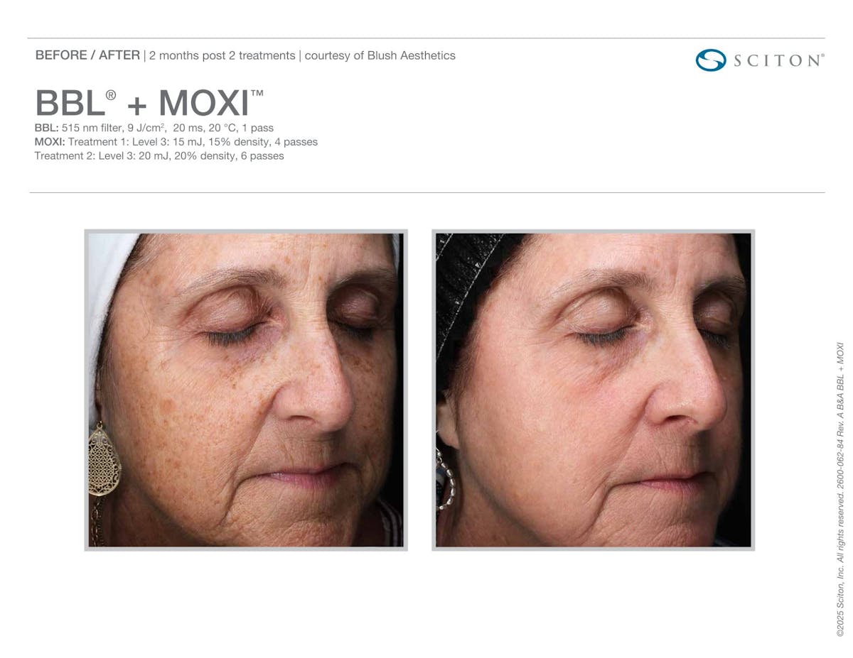 Moxi+BBL before and after