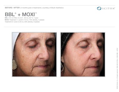 Moxi+BBL before and after