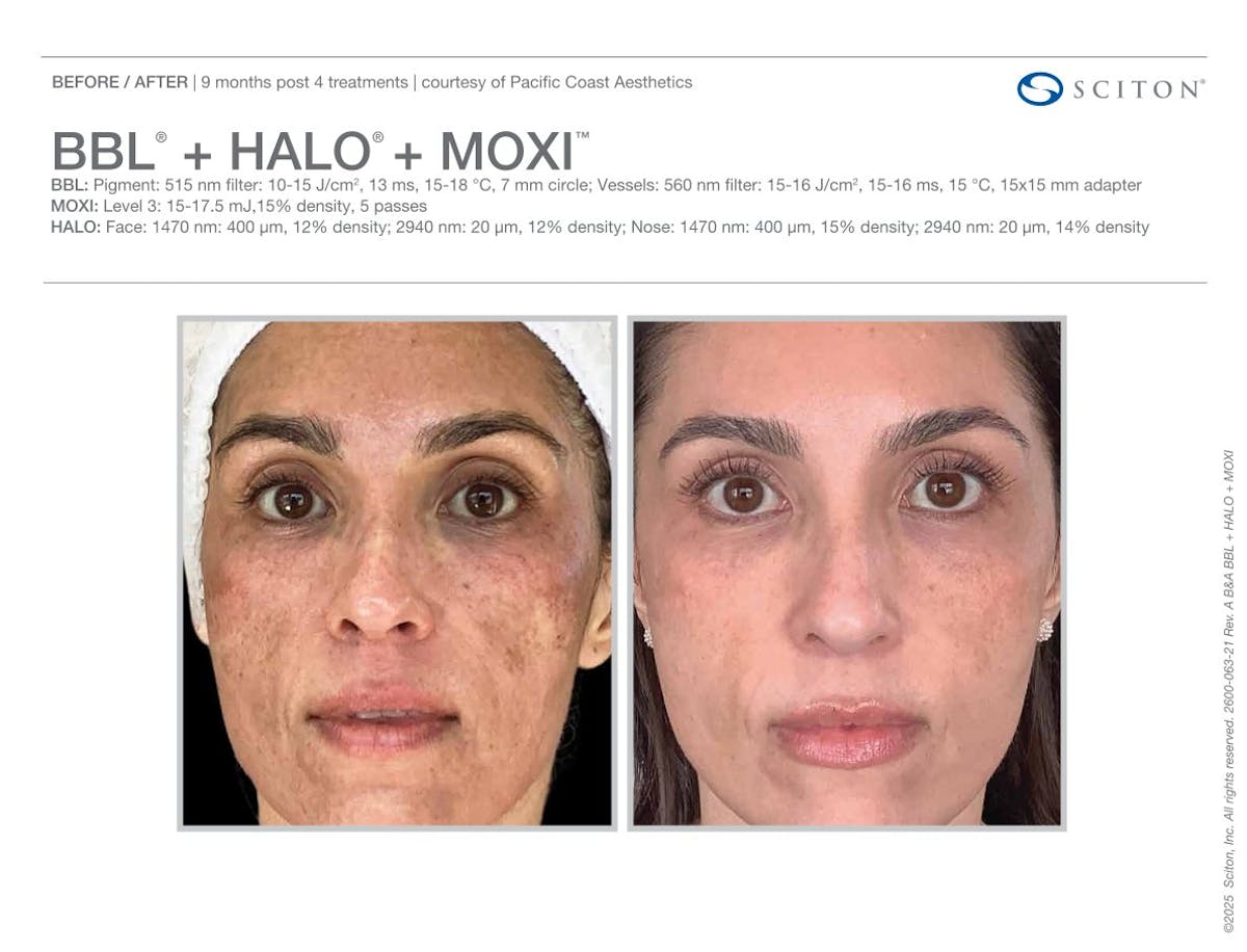 Moxi+BBL+Halo before and after