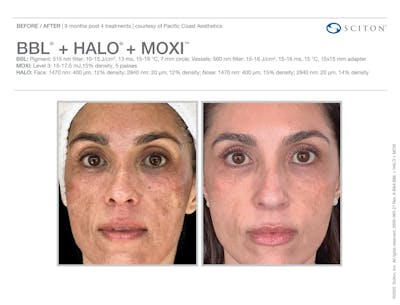Moxi+BBL+Halo before and after