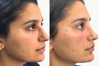 Facial Balancing Before & After Gallery - Patient 603243 - Image 1