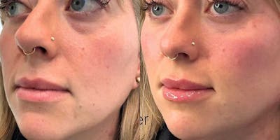 Facial Balancing Before & After Gallery - Patient 141151 - Image 1