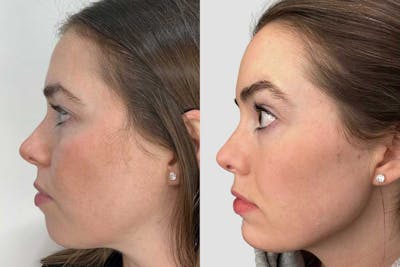 Facial Balancing Before & After Gallery - Patient 111403 - Image 1