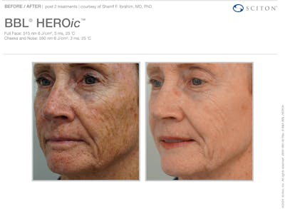 BBL Before & After Gallery - Patient 357215 - Image 1