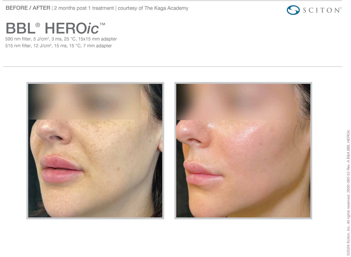 BBL Before & After Gallery - Patient 103585 - Image 1