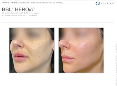 BBL Before & After Gallery - Patient 103585 - Image 1