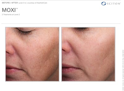 Moxi Before & After Gallery - Patient 344225 - Image 1
