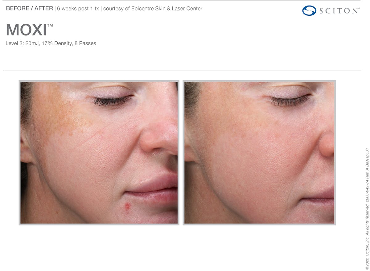Moxi Before & After Gallery - Patient 350842 - Image 1