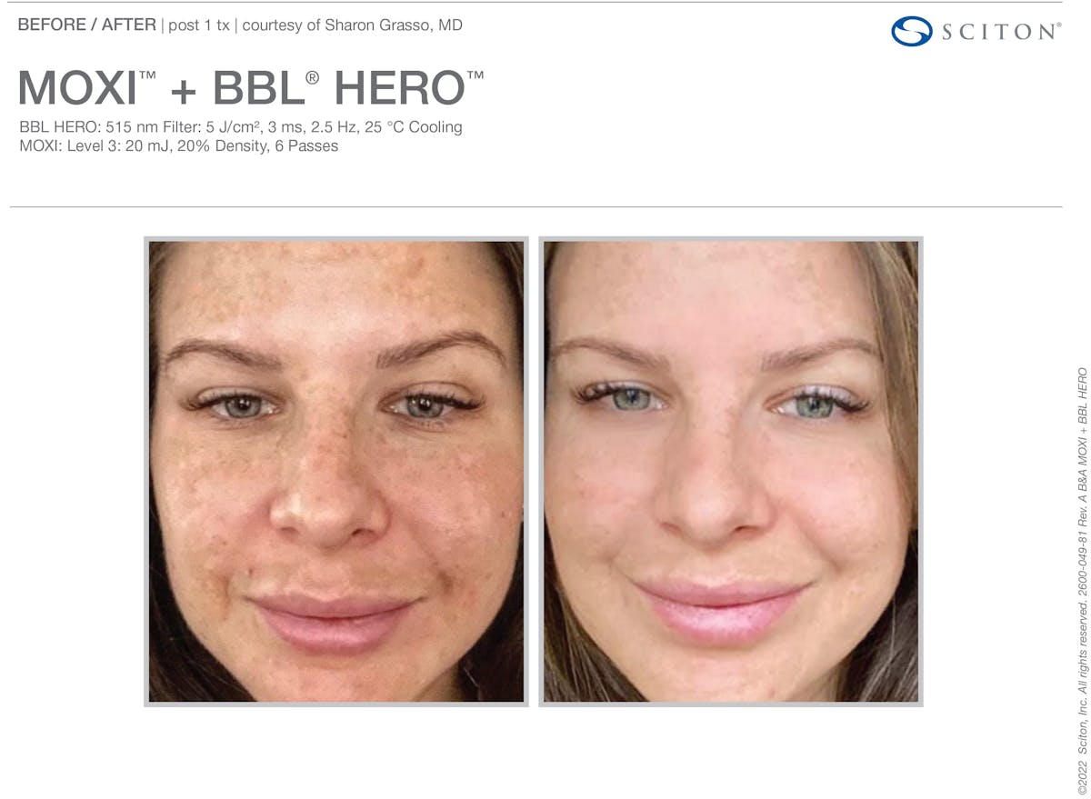 Moxi Before & After Gallery - Patient 371597 - Image 1