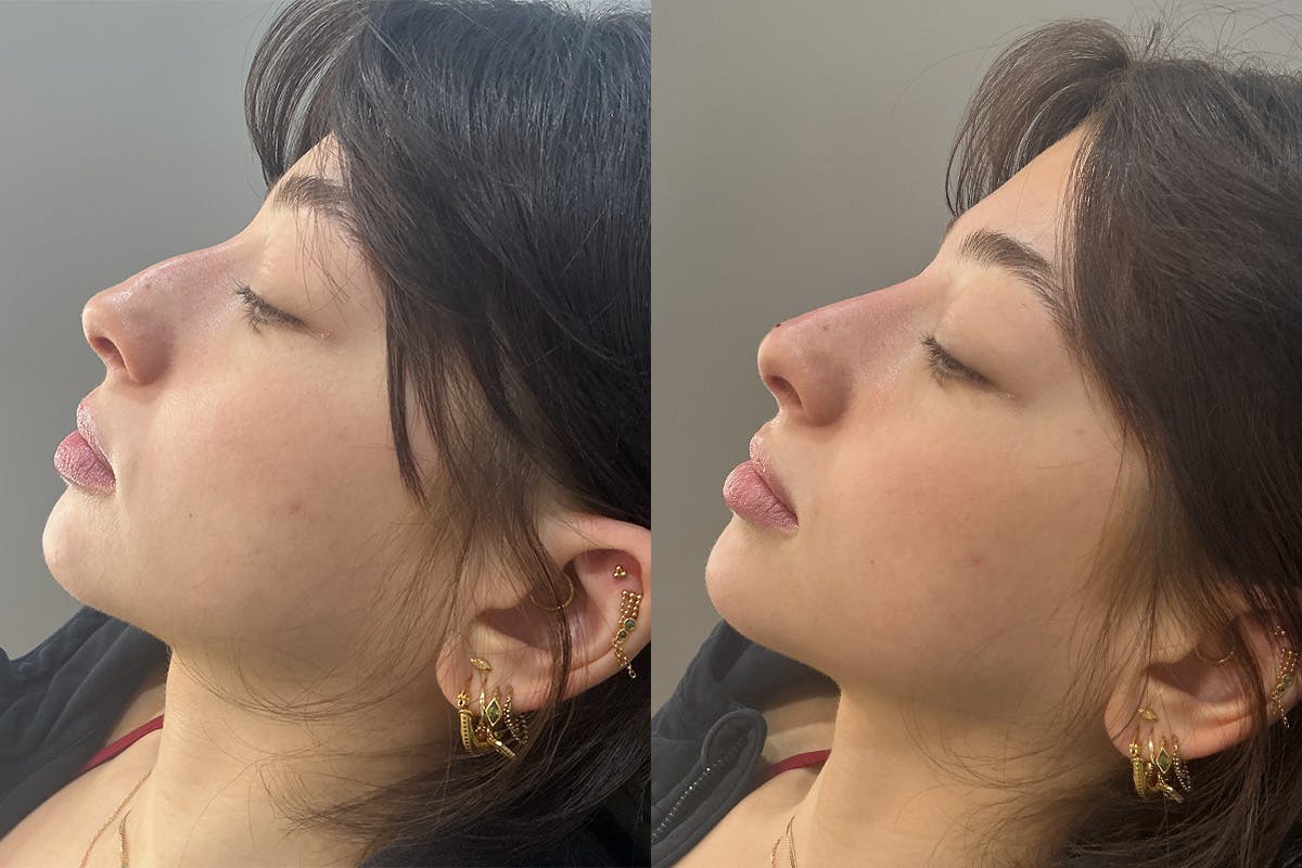 liquid rhinoplasty 1