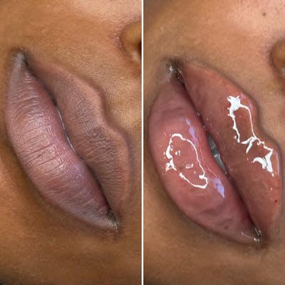 Lip Filler Before & After Gallery - Patient 334702 - Image 1