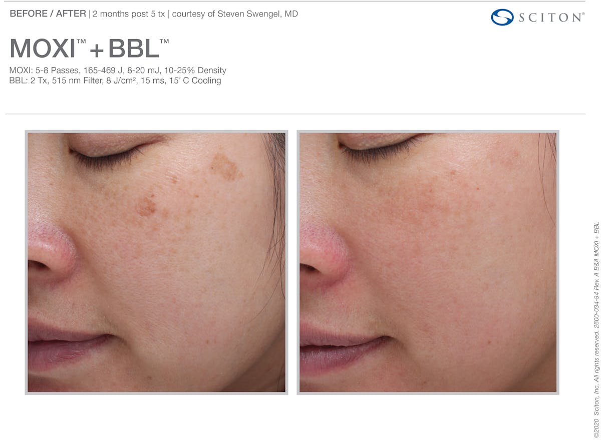 Moxi Before & After Gallery - Patient 267055 - Image 1