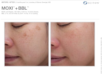 Moxi Before & After Gallery - Patient 267055 - Image 1