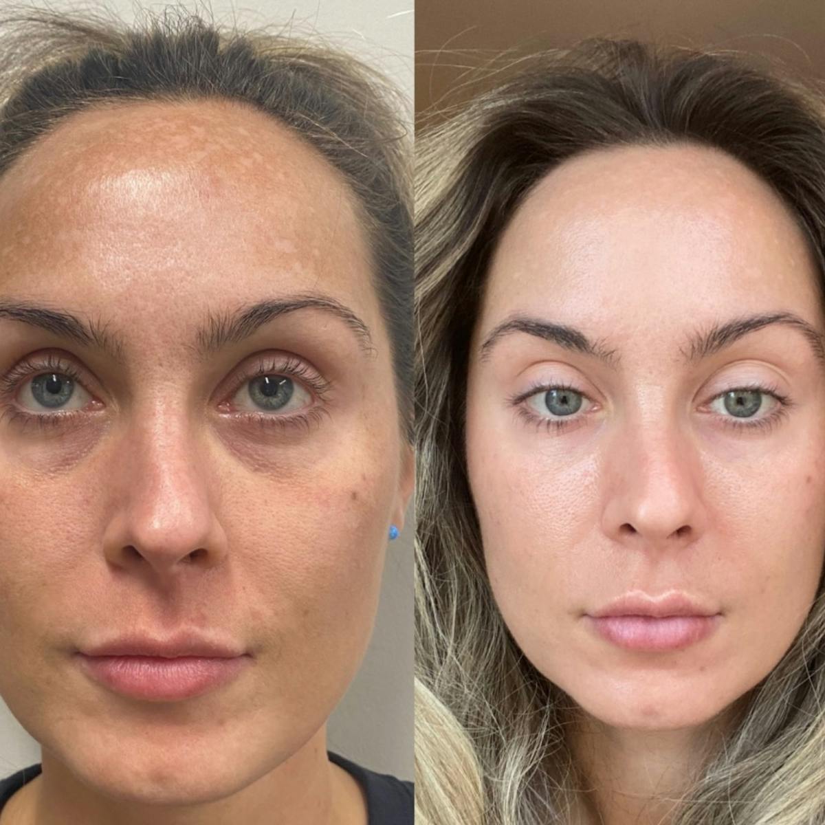 Moxi Before & After Gallery - Patient 416014 - Image 1