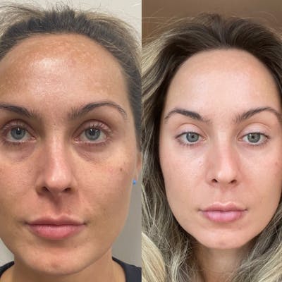 Moxi Before & After Gallery - Patient 416014 - Image 1