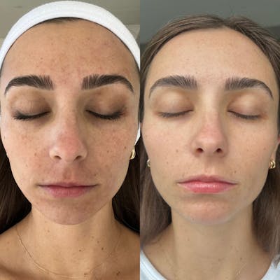 Moxi Before & After Gallery - Patient 615820 - Image 1