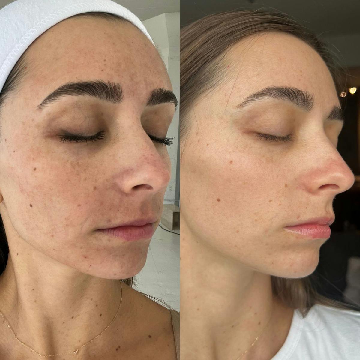 Moxi Before & After Gallery - Patient 615820 - Image 2