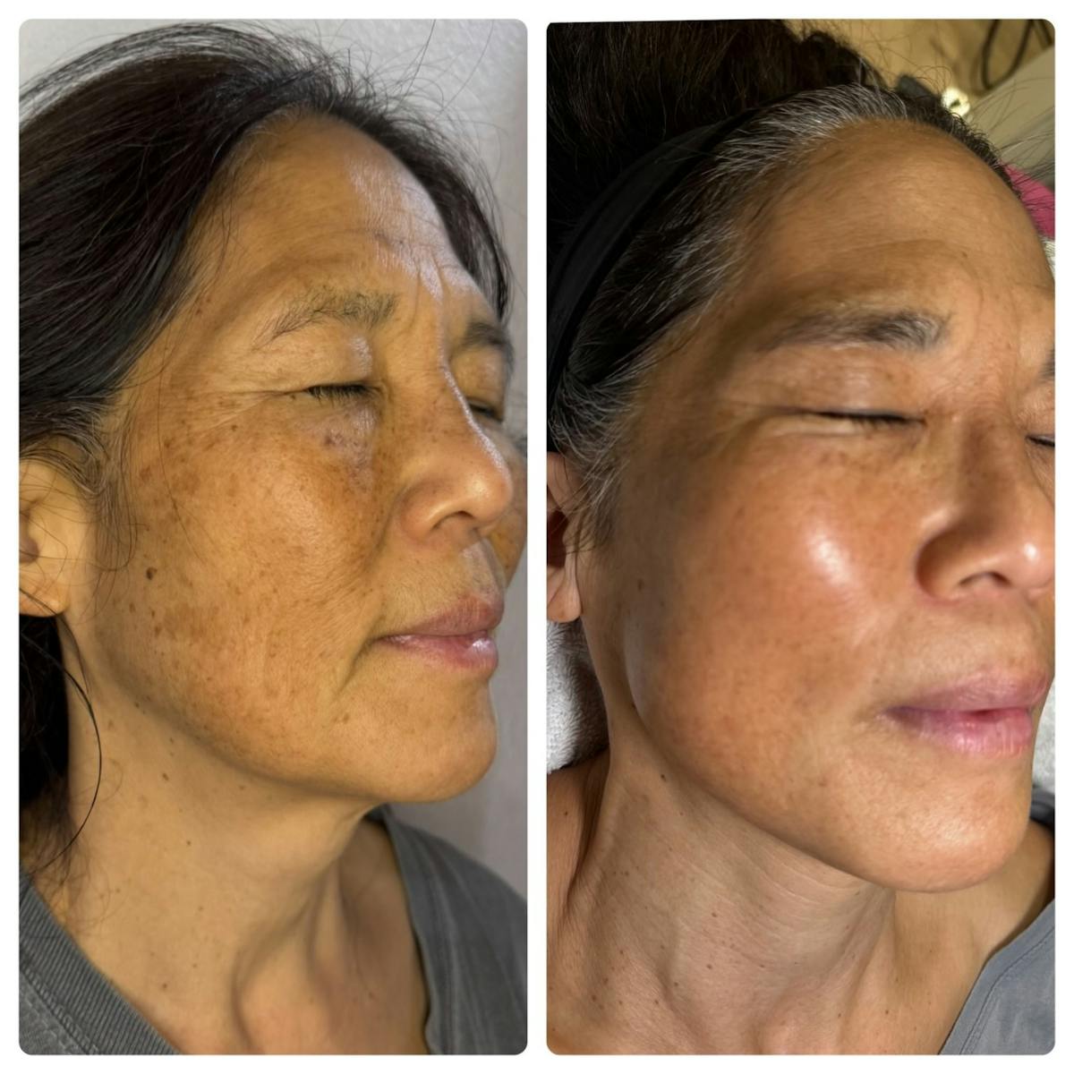 BBL Before & After Gallery - Patient 191460 - Image 1