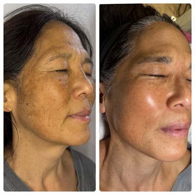 BBL Before & After Gallery - Patient 191460 - Image 1