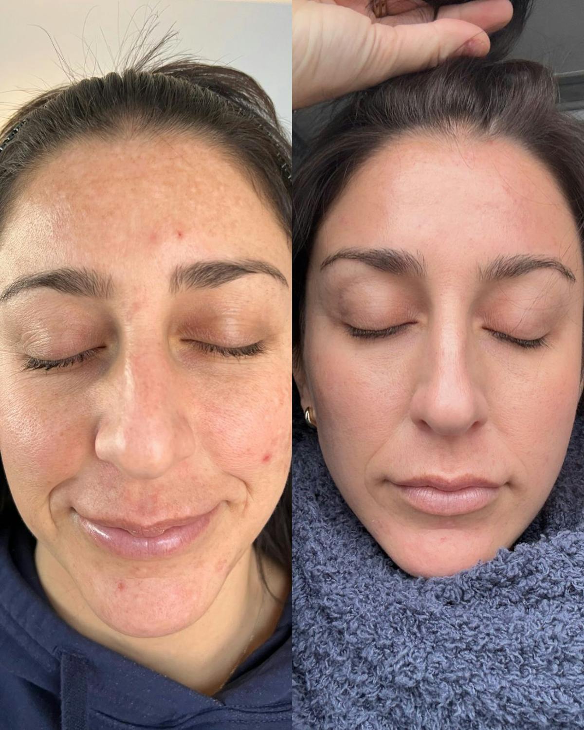 Moxi Before & After Gallery - Patient 393344 - Image 1