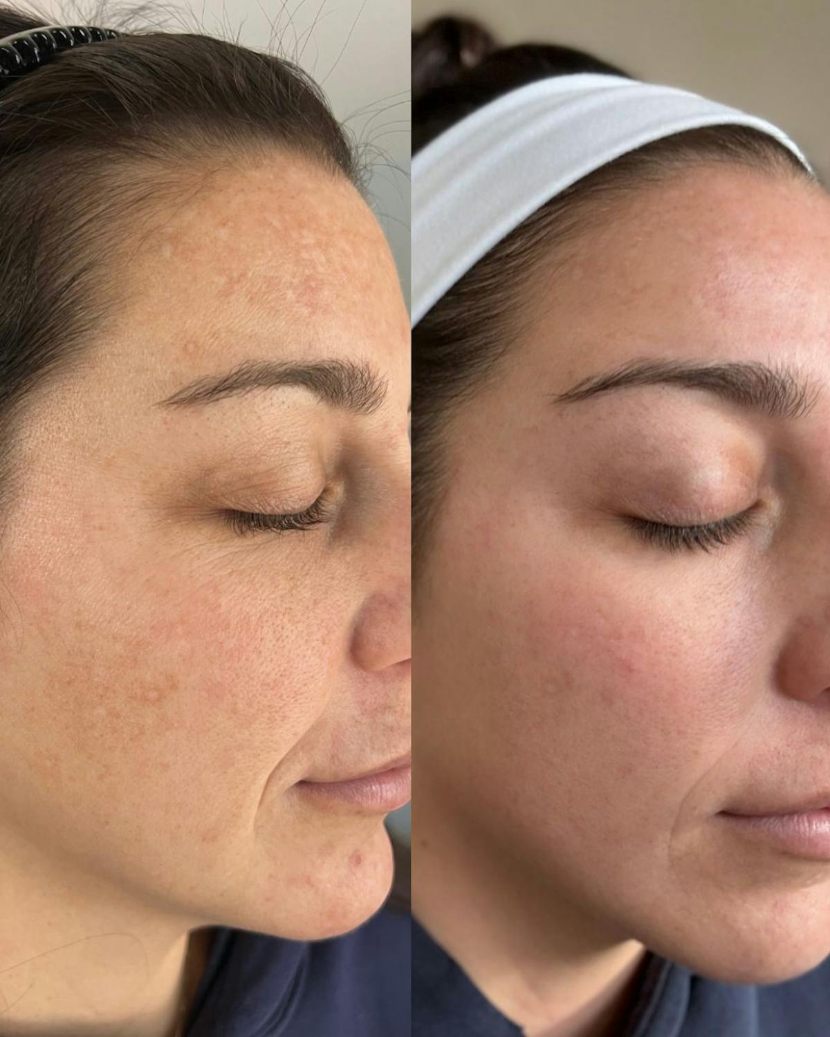 Moxi Before & After Gallery - Patient 393344 - Image 2