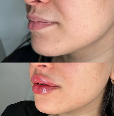 Lip Filler Before & After Gallery - Patient 321795 - Image 1