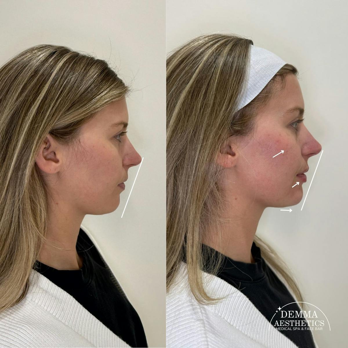 Facial Balancing Before & After Gallery - Patient 307374 - Image 1