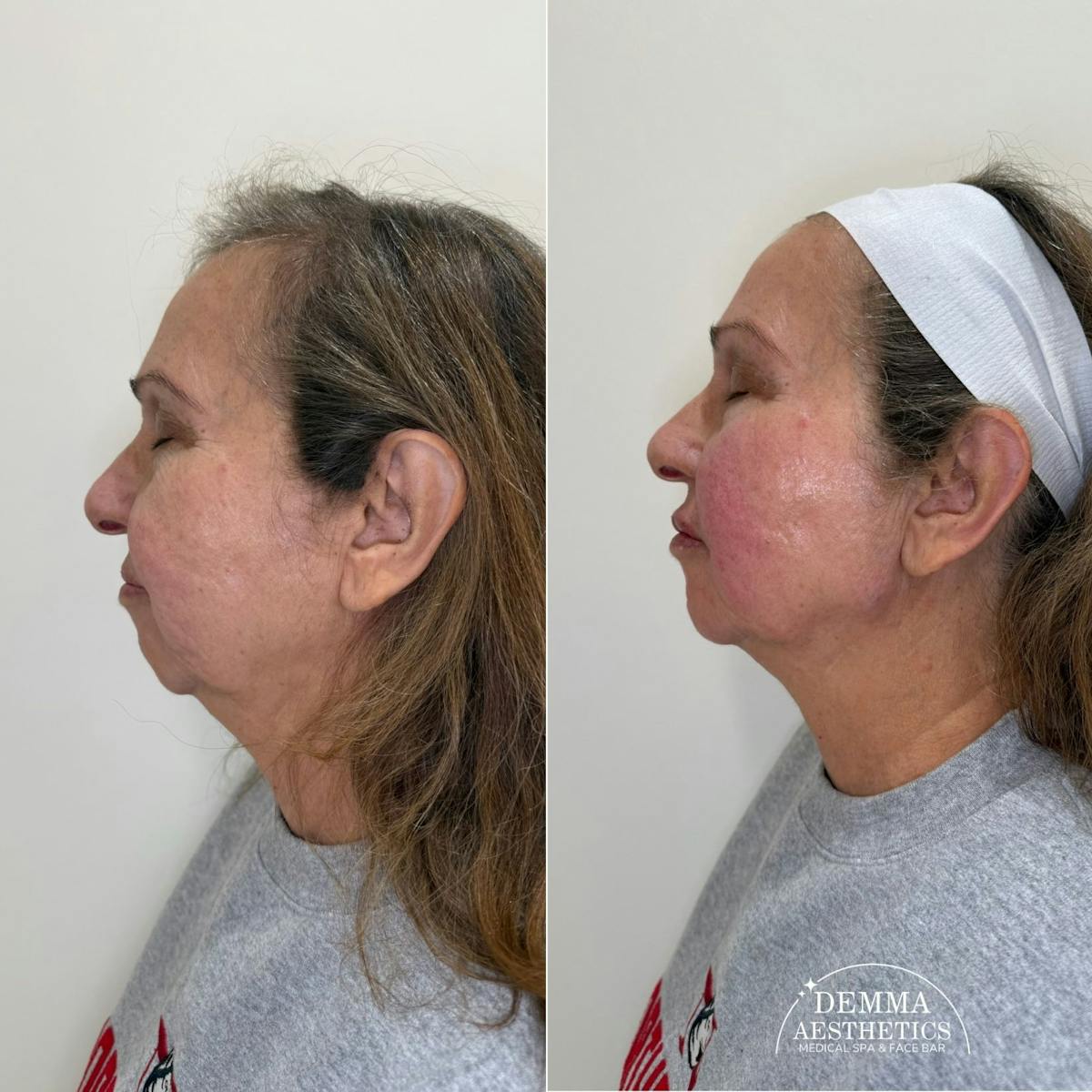 Facial Balancing Before & After Gallery - Patient 145577 - Image 1