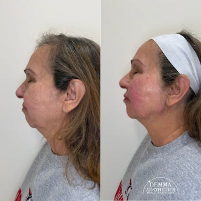Facial Balancing Before & After Gallery - Patient 145577 - Image 1