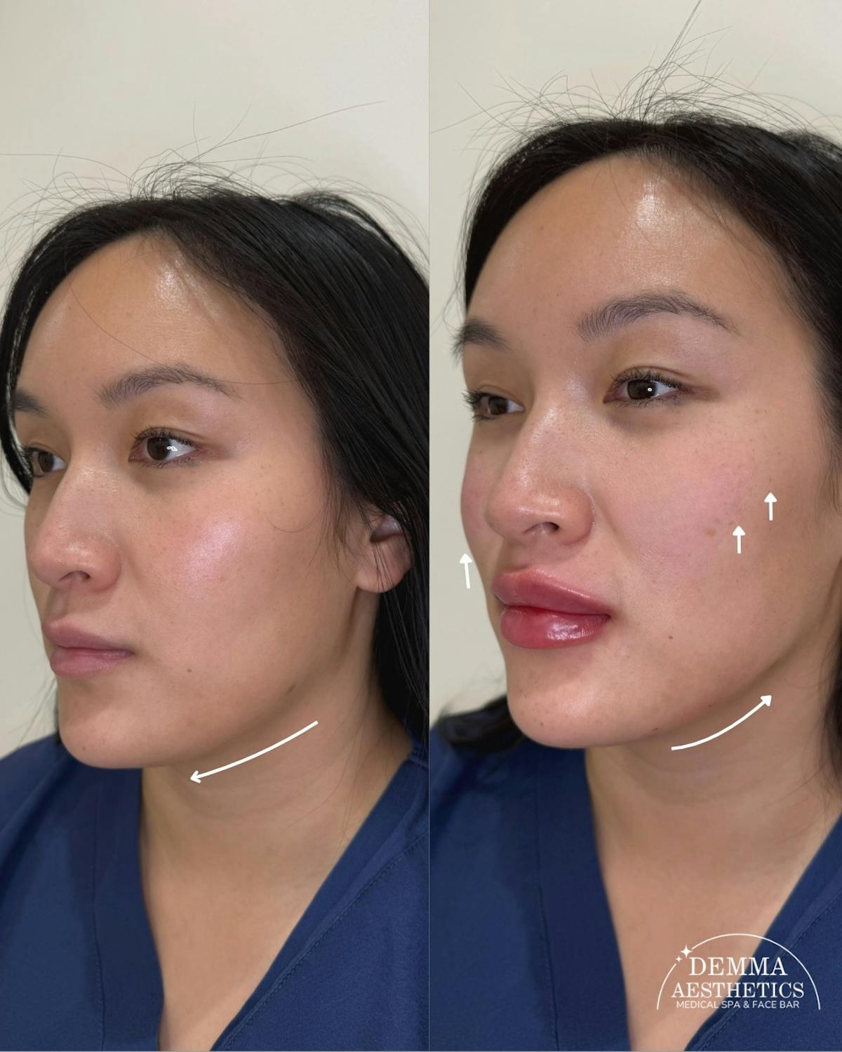 Facial Balancing Before & After Gallery - Patient 793906 - Image 1