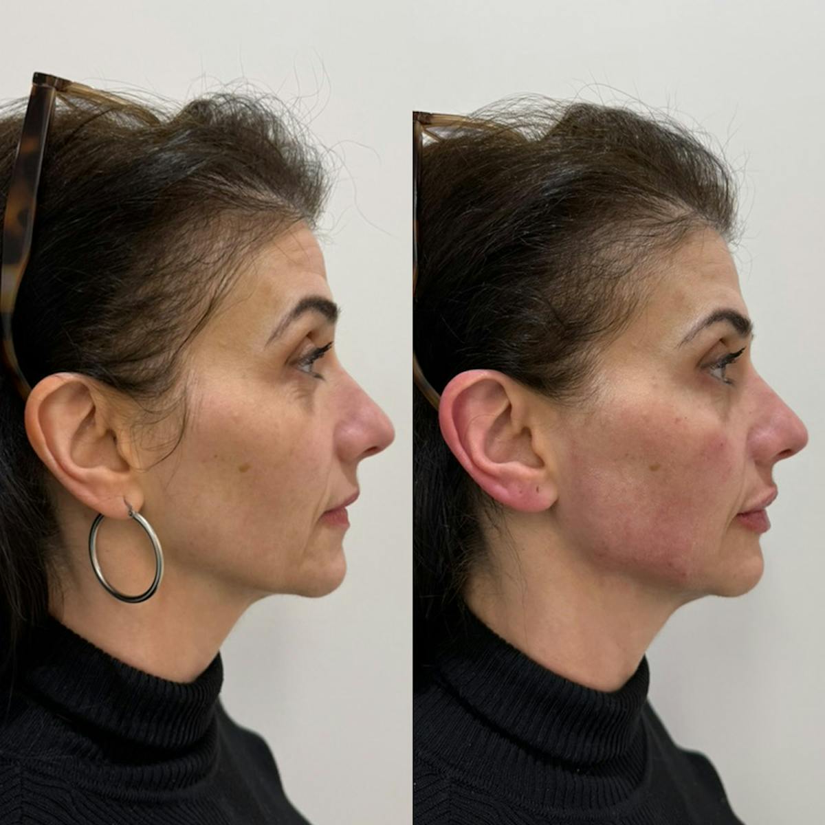 Facial Balancing Before & After Gallery - Patient 280645 - Image 2