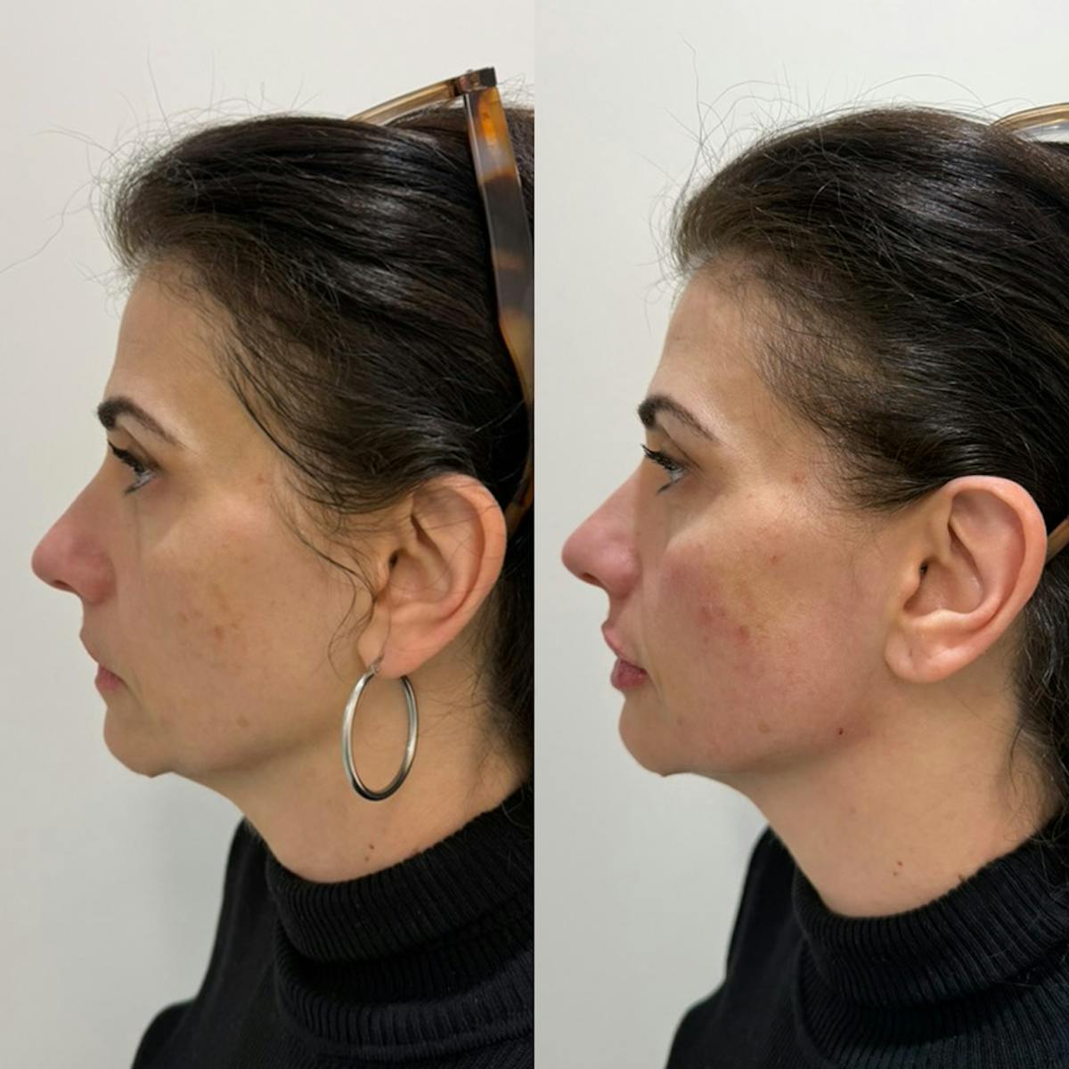 Facial Balancing Before & After Gallery - Patient 280645 - Image 1