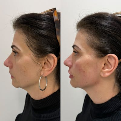 Facial Balancing Before & After Gallery - Patient 280645 - Image 1