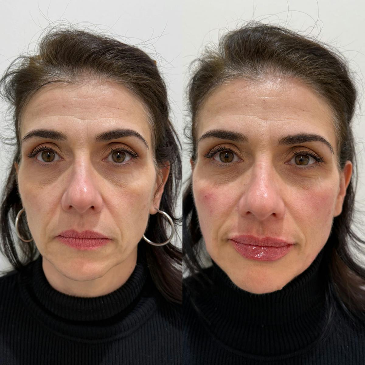 Facial Balancing Before & After Gallery - Patient 280645 - Image 3